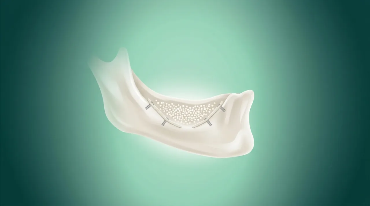 Nu ai os la mandibulă și ți s-a spus că nu se poate pune implant?